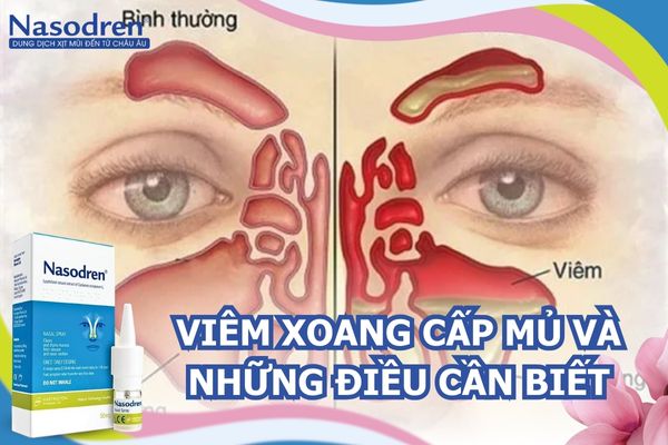 viêm xoang cấp mủ và những điều cần biết 2