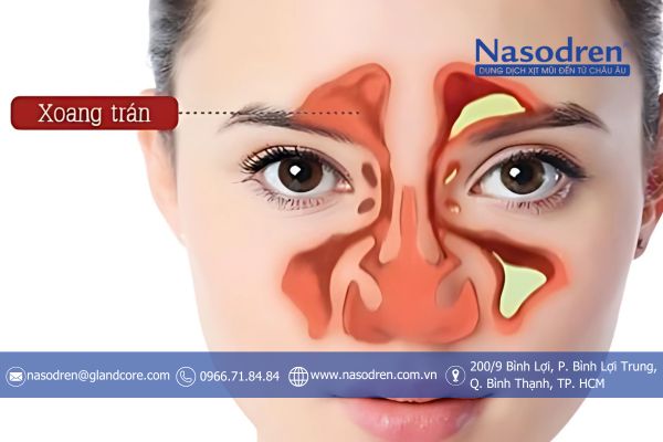 bệnh viêm xoang trán