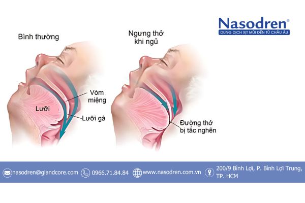 ngừng thở khi ngủ