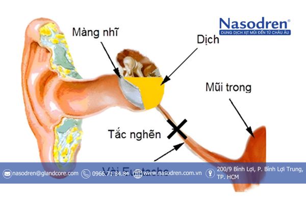 tắc nghẽn vòi nhĩ